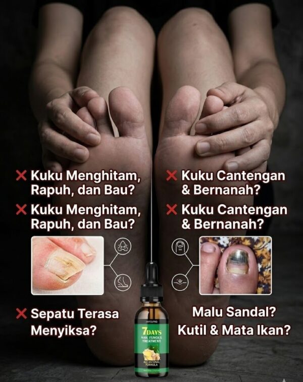 Masalah Kuku Cantengan